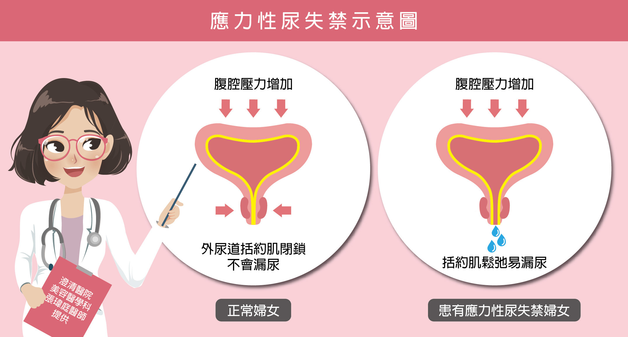 ▲▼打噴嚏就漏尿。（圖／澄清醫院提供）