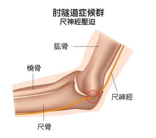 ▲▼肘隧道症候群。（圖／中國醫藥大學新竹附設醫提供）